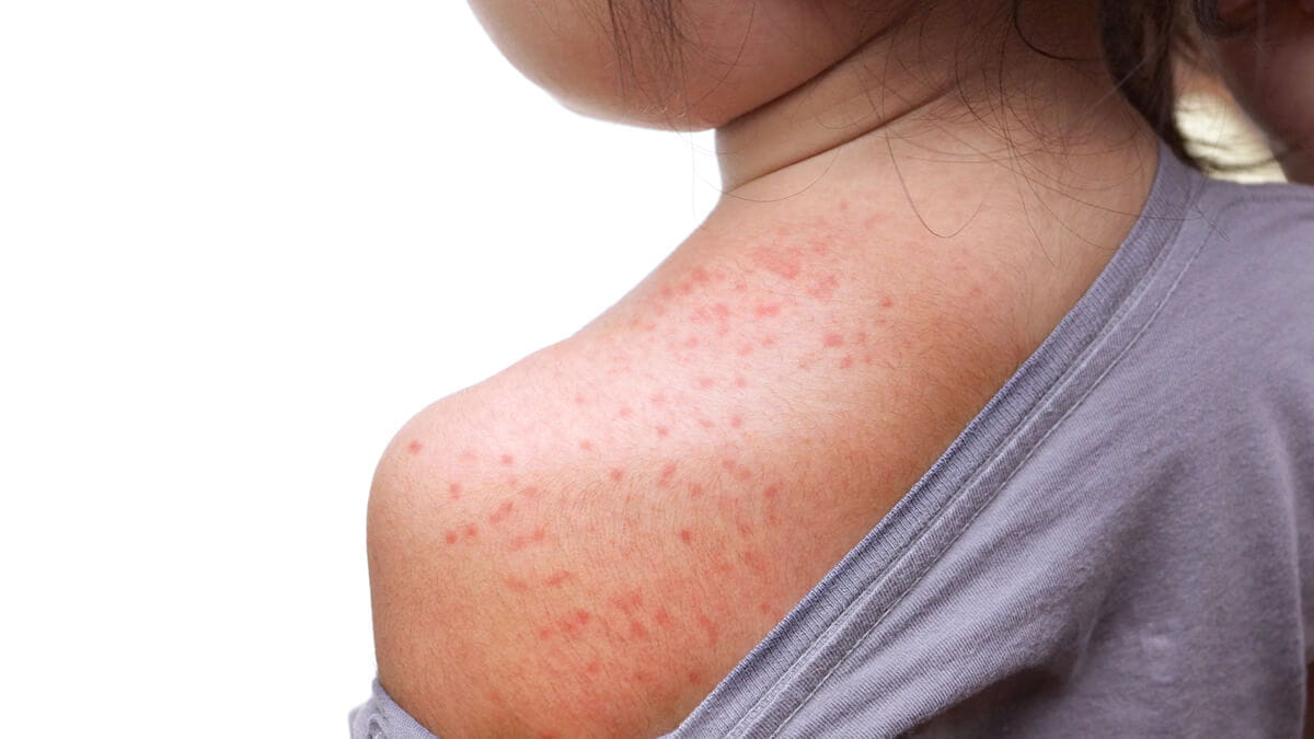 The Rising Concern Over Measles: What Every Nurse Should Know